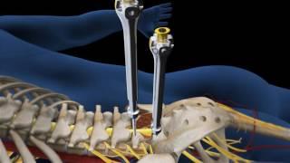 Lumbar Fusion of L5 S1 Animation