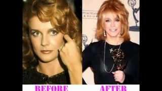 Ann Margret plastic surgery before and after photos