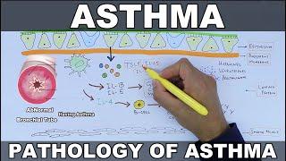 Asthma  Pathophysiology of Asthma