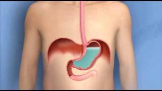 Heartburn Acid Reflux GERD-Mayo Clinic