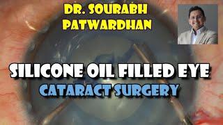 66 Phaco in silicone oil filled eye Important tips Dr Sourabh Patwardhan