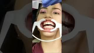 Dentist uses lip retractor with tongue guard to put braces on girl #dentist #fillings #teeth #dental