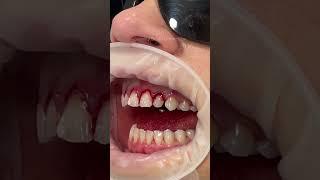 This technique is known as a gum lift gum contouring or gum augmentation 