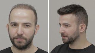 PROTEZ SAÇ NASIL YAPILIR? - Hair Replacement