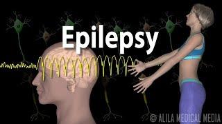 Epilepsy Types of seizures Symptoms Pathophysiology Causes and Treatments Animation.