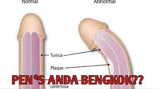 CARA MELURUSKAN PENIS BENGKOK ‼️by Dr BOBBY