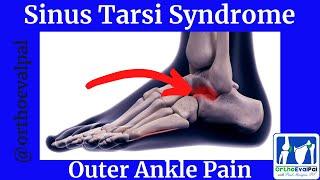 Sinus Tarsi Syndrome Outer Ankle Pain