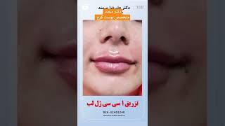 #تزریق_ژل #تزریق_بوتاکس #تزریق_چربی تزریق یک سی سی ژل لب کرج دکتر میمند متخصص پوست کرج #skincare