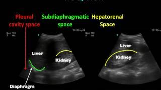 Basic Ultrasound Course EFAST