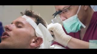 Stevens FUE Hair Transplant Procedure