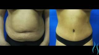 Tummy Tuck Before and After Photos in Connecticut