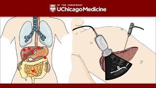 Understanding Neuroendocrine Tumors