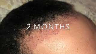 Trapianto Capelli Giorno per Giorno da giorno 1 a 6 mesi - Hair transplant Day By Day