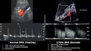 Superior Mesenteric Artery SMA Doppler Ultrasound Normal Vs Abnormal Images  Vascular USG Cases