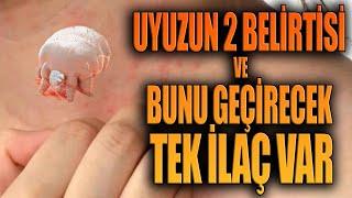 Uyuzun 2 Belirtisi ve Bunu Geçirecek Tek İlaç Var