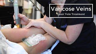 Getting Rid of Varicose Veins  Laser Spider Vein Treatment