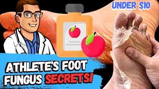 Athletes Foot Fungus Cure Apple Cider Vinegar Treatment