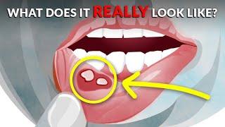 What Does A Canker Sore Look Like?