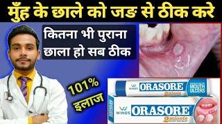 मुहँ के छालों की बेस्ट जेल- orasore gel for mouth ulcer  mouth ulcer treatment in hindiorasore gel