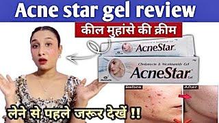 Acne star gel reviewlAcne star creaml Usesside-effects Remove acnelpimples BlackheadsReview 2024