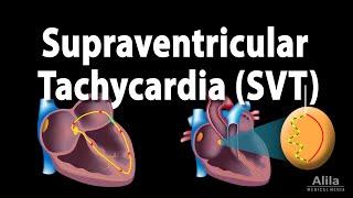 Supraventricular Tachycardia SVT PSVT Animation