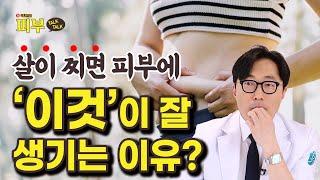 다이어트 하면 좋아지는 피부 질환? 사마귀를 치료하면 살이 빠진다? - 박치영의 피부 톡톡 #130