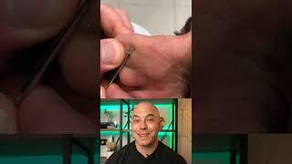 Doctor reacts to a great tool used to extract pimples or small cysts #dermreacts #doctorreacts