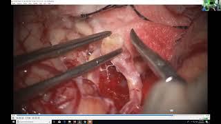 Complications in Skull Base Surgery with Iype Cherian on Neurosurgical TV