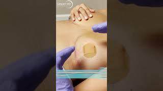 Deep Scar Massage After Explant