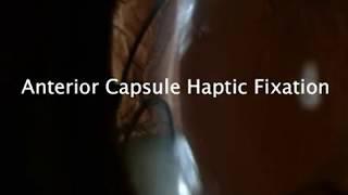 Managing a Dislocated Intraocular Lens by Anterior Capsule Haptic Fixation a new original technique