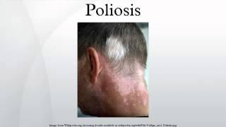 Poliosis