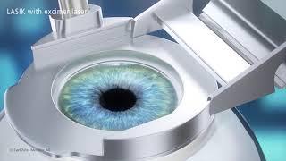 LASIK Treatment Animation