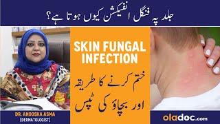 Skin Fungal Infection Treatment In UrduHindi- Dad Khad Ka Ilaj - Skin Pe Fungus Kese Hota Hai