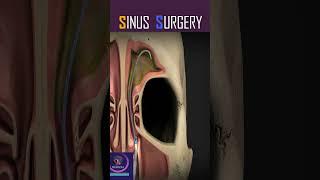 Ballon Sinuplasty Sinus Surgery #shorts