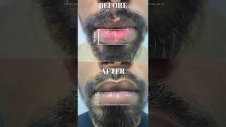 Lip debulking surgery #celebritysurgeon #lipdebulkingsurgery #lipdebulking #lipsurgery