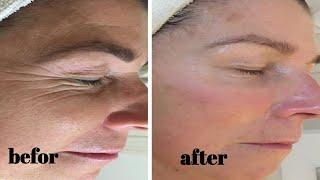 The miracle of Japanese women in removing wrinkles - Wrinkle treatment in a week