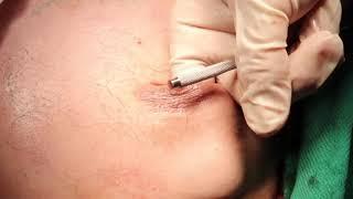Breast Bud Removal  Gynecomastia With Dr. S. Saul Lahijani MD