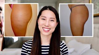 how to get rid of cellulite  a proven effective method  Chris Han
