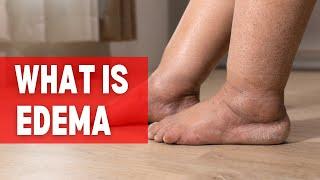 What is Edema - what is edema ?  edema causes  edema types  edema treatment