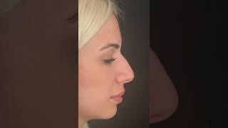 Rhinoplasty operasyonu öncesi ve sonrası #gürayyeşiladalı #rinoplasti