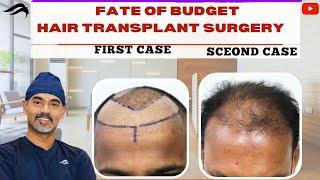 Cost Of Hair Transplant In India  How Much Does Hair Transplant Cost In India