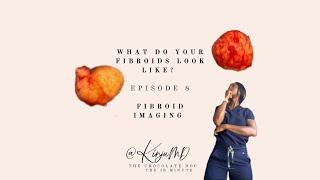 What do your fibroids look like?  #TheIRMinute EP 8 - Fibroid Imaging