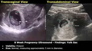 8 Week Pregnancy Obstetric Ultrasound Report Example  Normal Intrauterine Pregnancy USG  OB-GYN