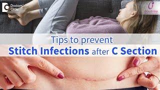 C-Section Stitch InfectionsSigns Prevention & Treatment  Immediate Care-Dr.Shashikala Hande of C9