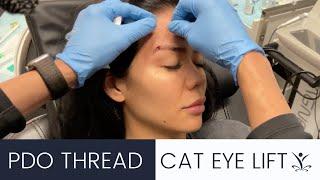 Get a Cat Eye Lift with PDO Threads