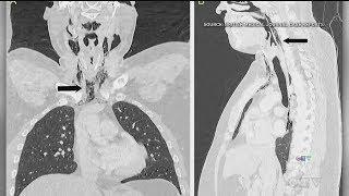 Trying to stifle a sneeze could lead to internal damage