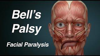 Bells Palsy One Sided Facial Paralysis