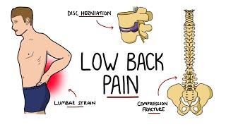 Low Back Pain Explained Including Red Flags