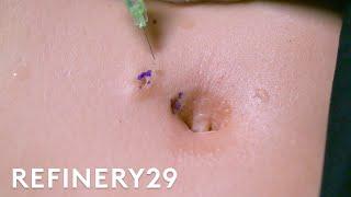 I Got The Belly Button Piercing Removal Surgery  Macro Beauty  Refinery29