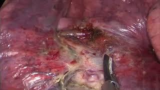 Asvide Uniportal video-assisted thoracic surgery left lower lobe wedge resection guided by…